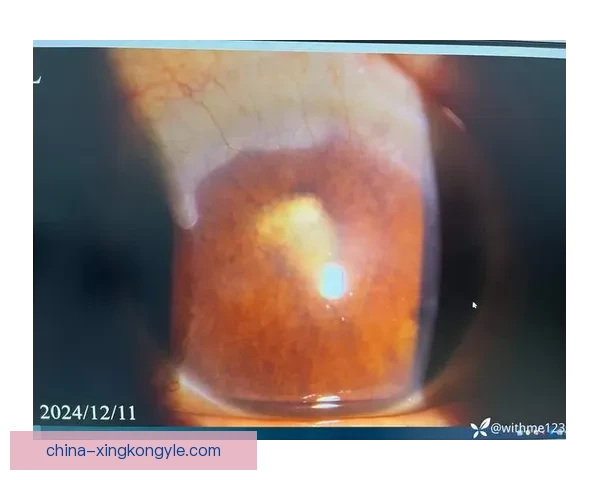 国王官宣亨特左眼虹膜炎需复查